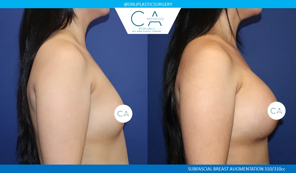 Asian Breast Augmentation case #9574