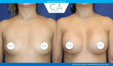 Asian Breast Augmentation case #9562