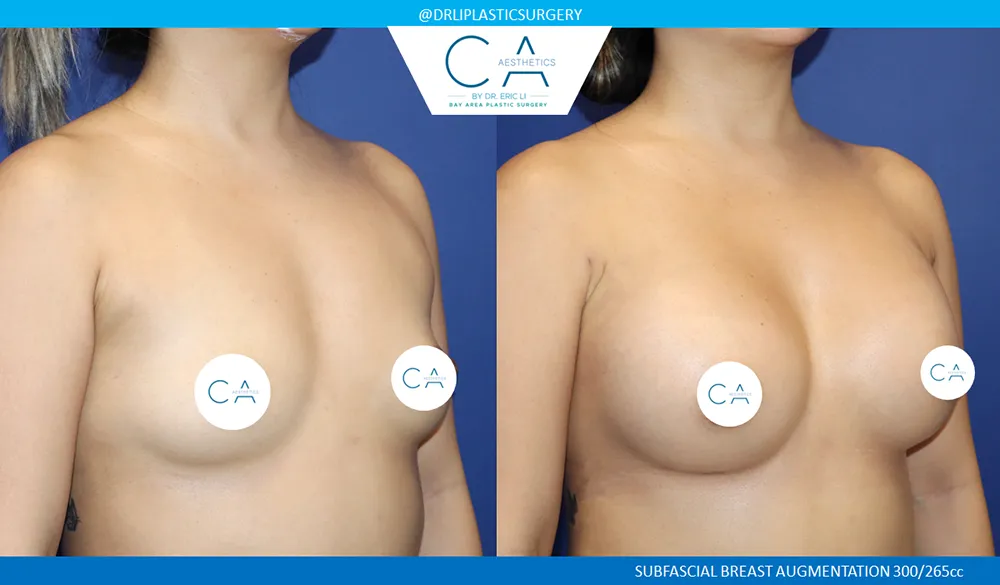 Asian Breast Augmentation case #9562