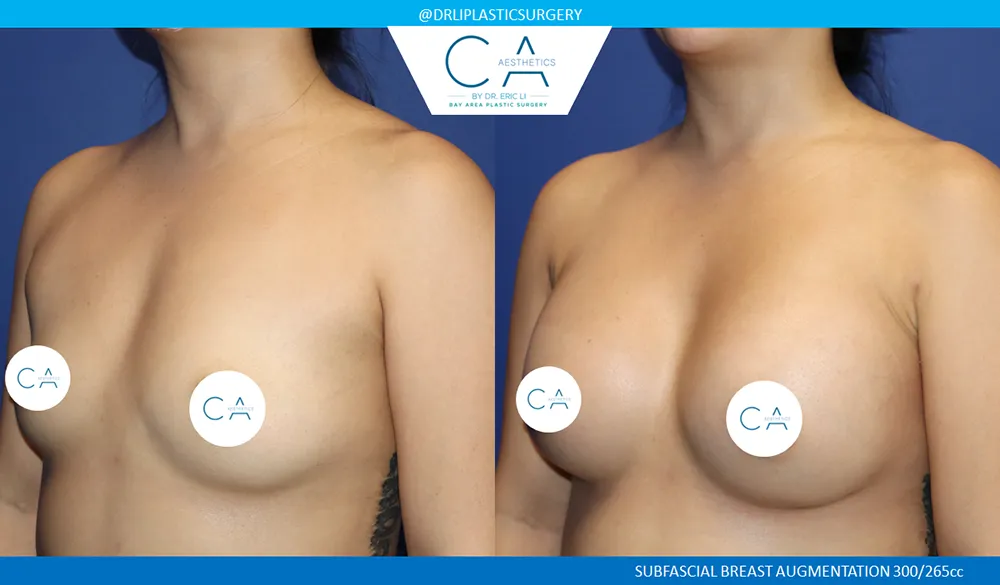 Asian Breast Augmentation case #9562