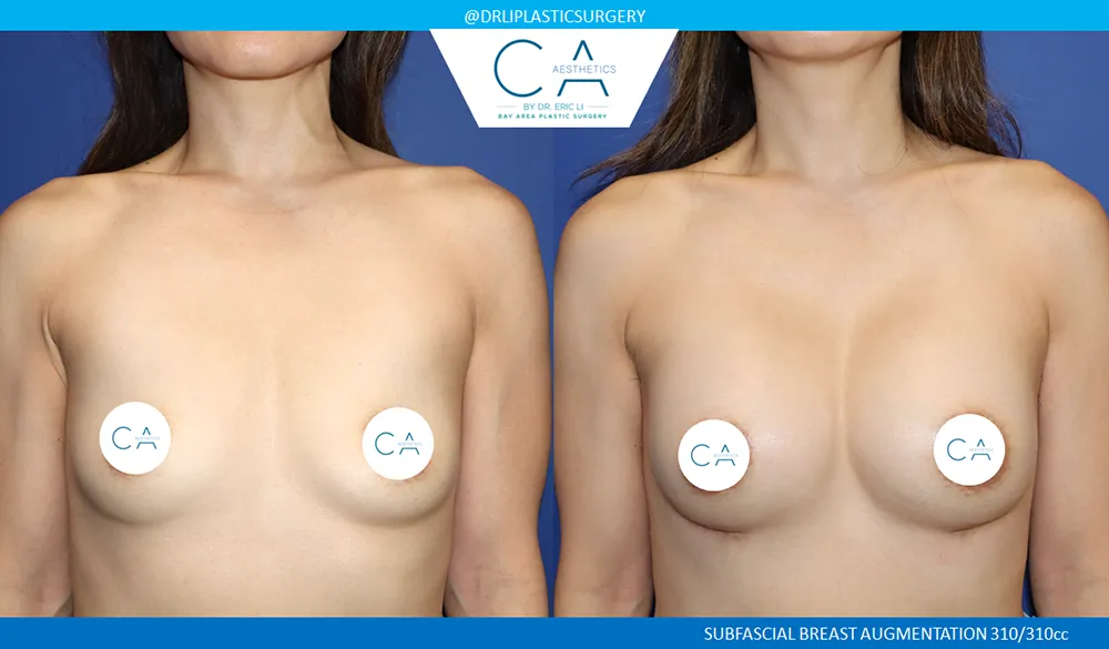 Asian Breast Augmentation case #9556