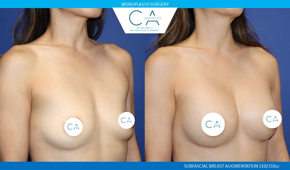 Asian Breast Augmentation case #9556