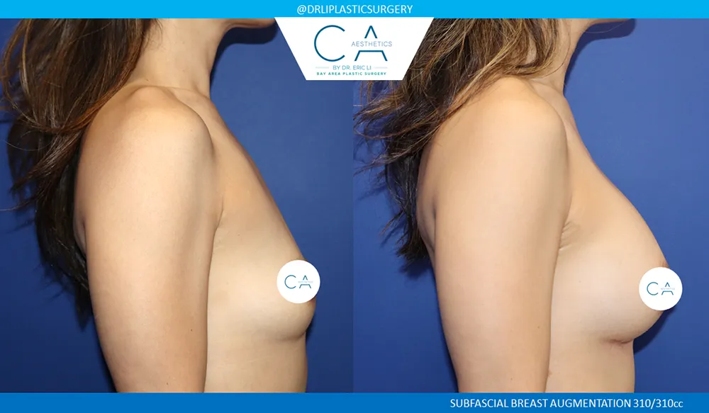 Asian Breast Augmentation case #9556