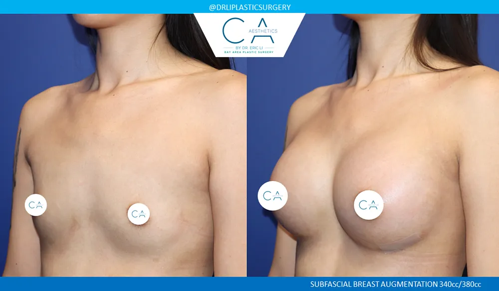 Asian Breast Augmentation case #9546