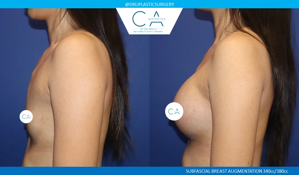 Asian Breast Augmentation case #9546