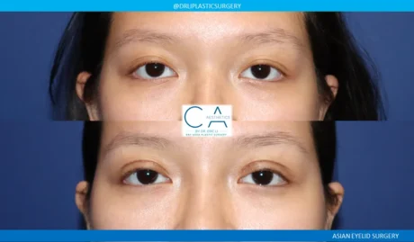 Asian Eyelid case #9382