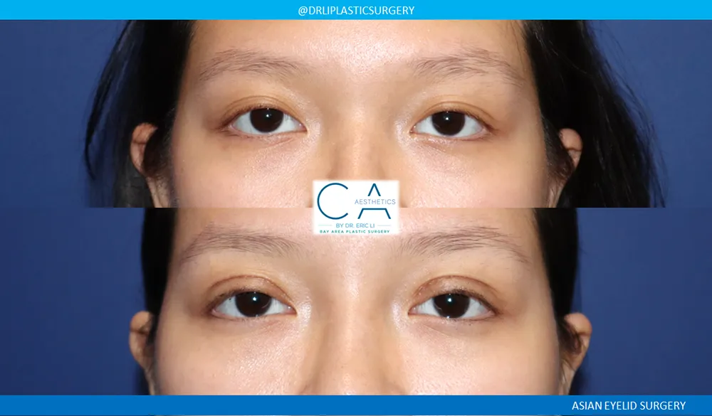 Asian Eyelid case #9382