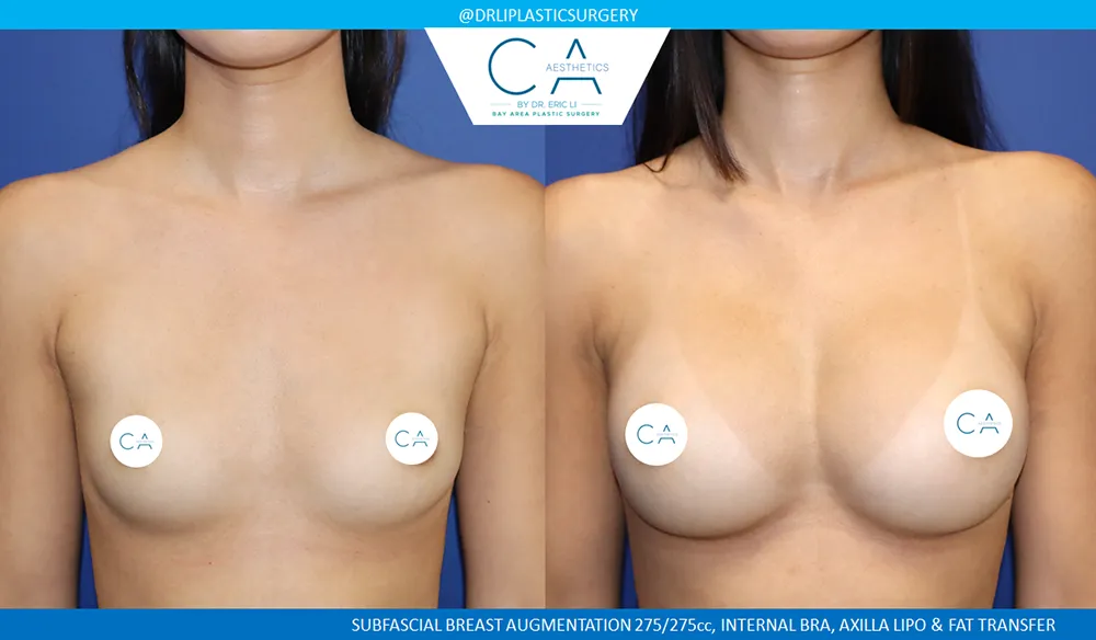 Breast Augmentation case #9617