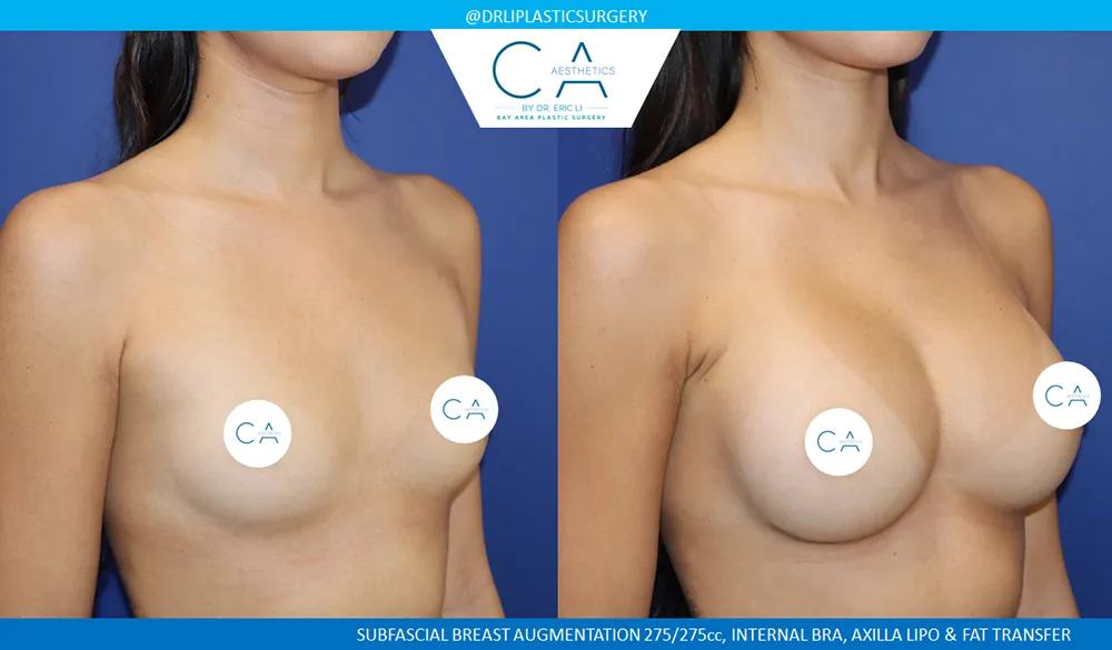 Breast Augmentation case #9617