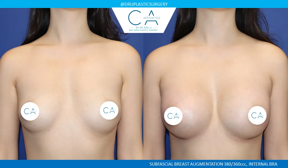 Breast Augmentation case #9611