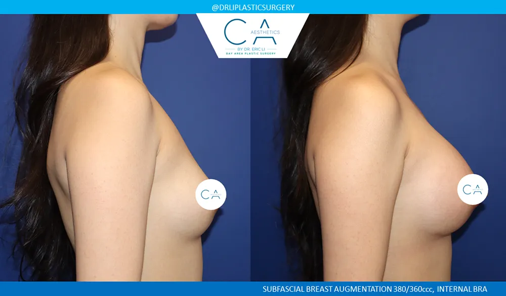 Breast Augmentation case #9611