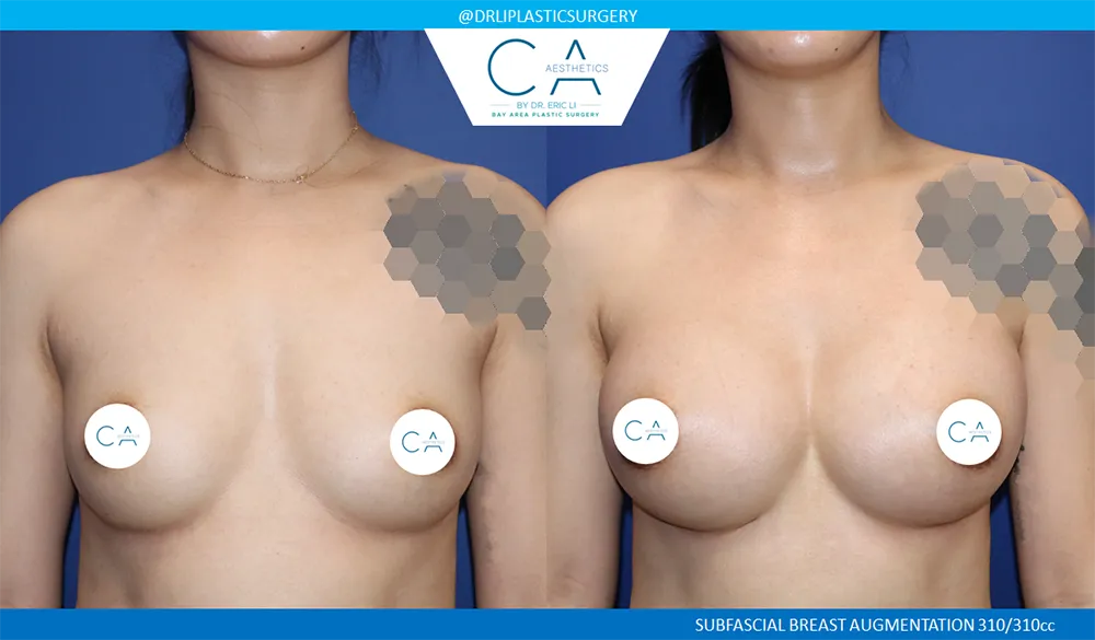 Breast Augmentation case #9605