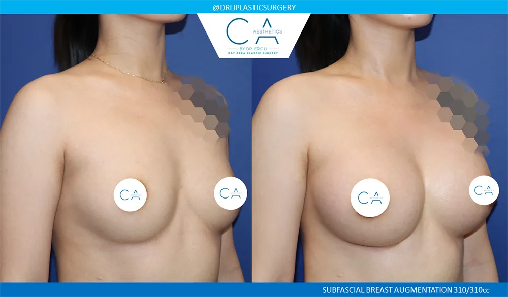 Breast Augmentation case #9605