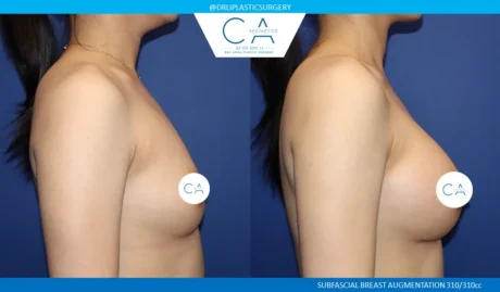 Breast Augmentation case #9599