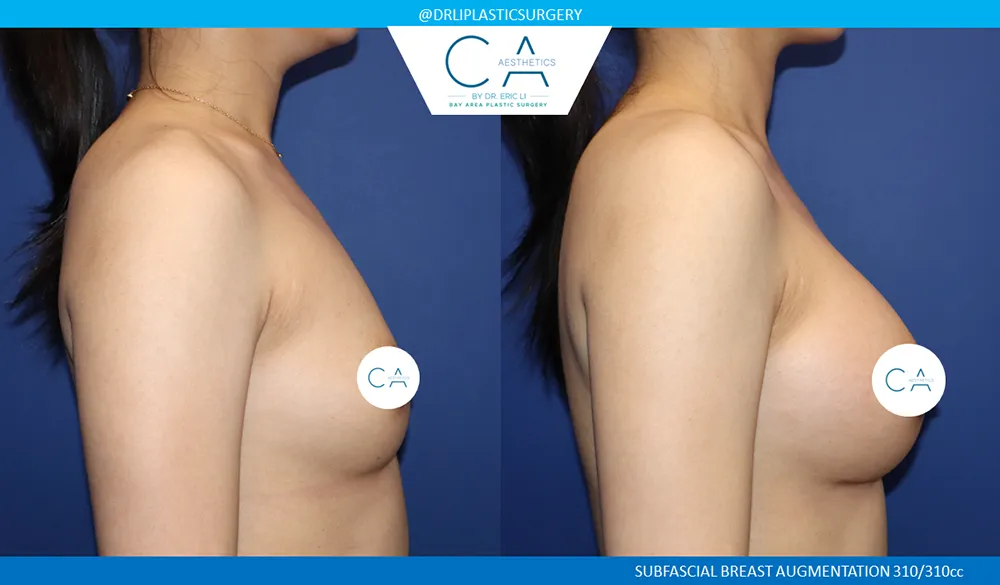 Breast Augmentation case #9599