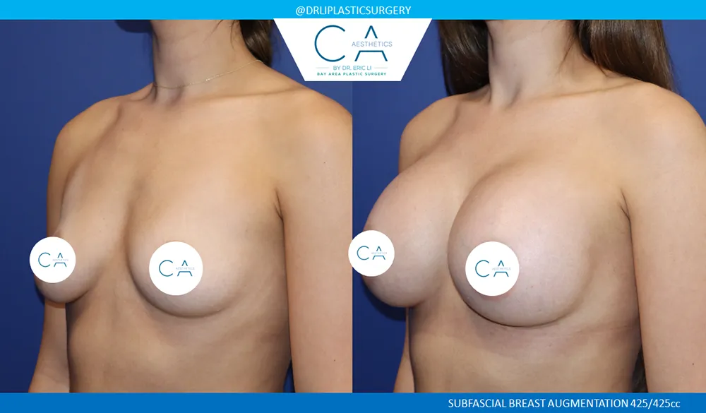 Breast Augmentation case #9599