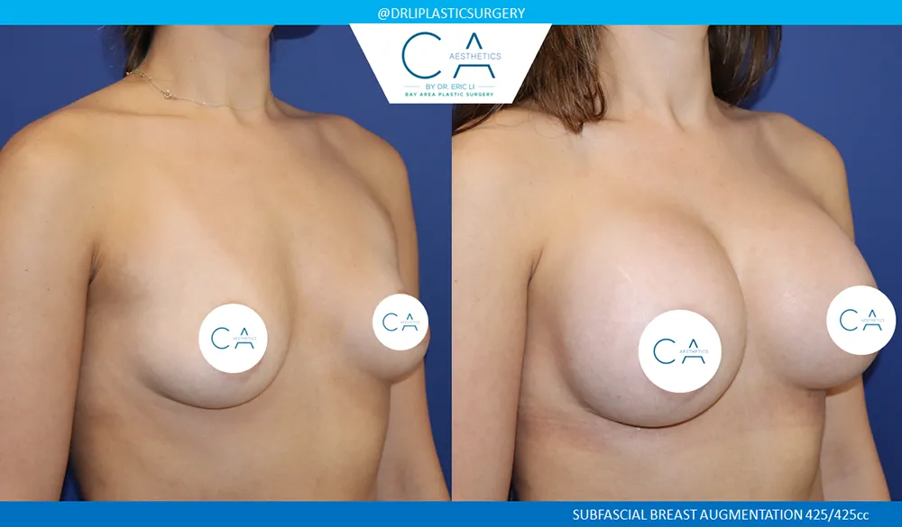 Breast Augmentation case #9599