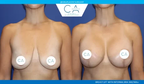Breast Lift case #9429