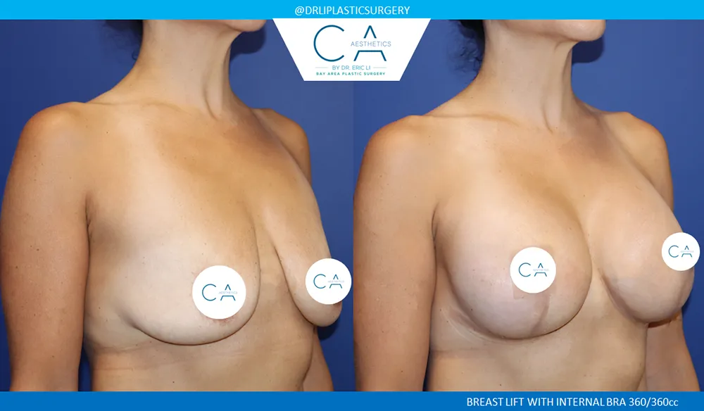 Breast Lift case #9429