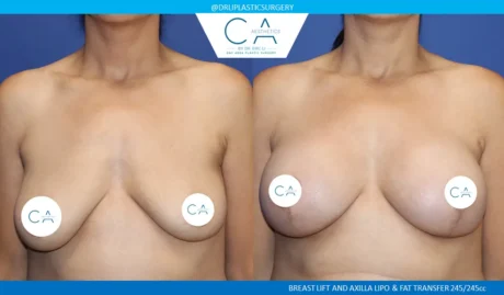 Breast Lift case #9423