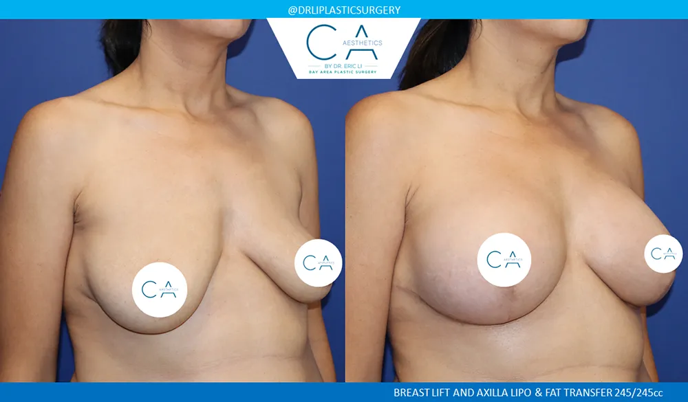 Breast Lift case #9423