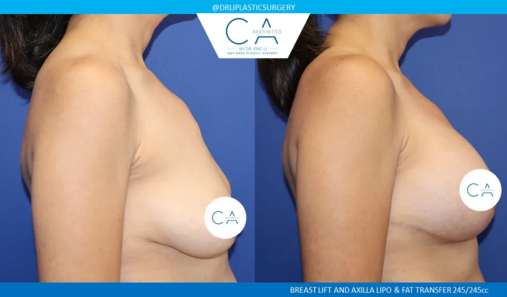 Breast Lift case #9423