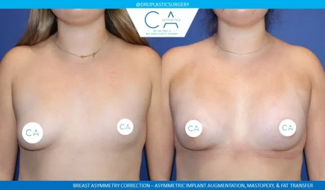 Breast Lift case #9411