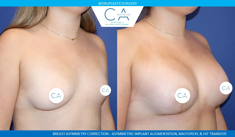 Breast Lift case #9411