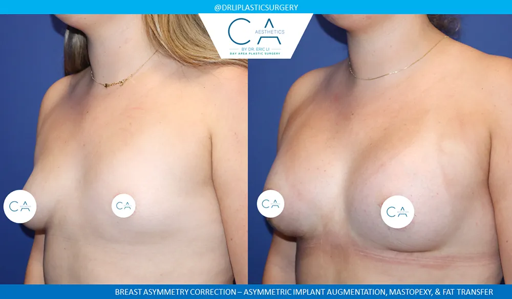 Breast Lift case #9411
