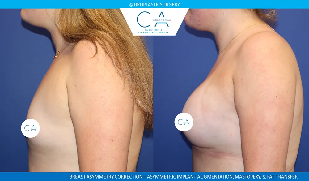 Breast Lift case #9411