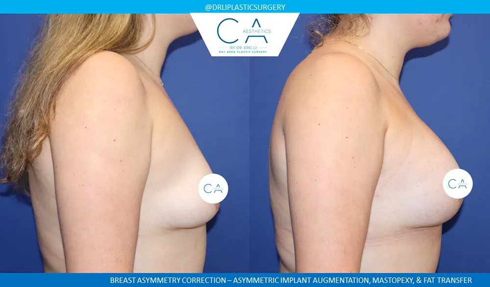 Breast Lift case #9411
