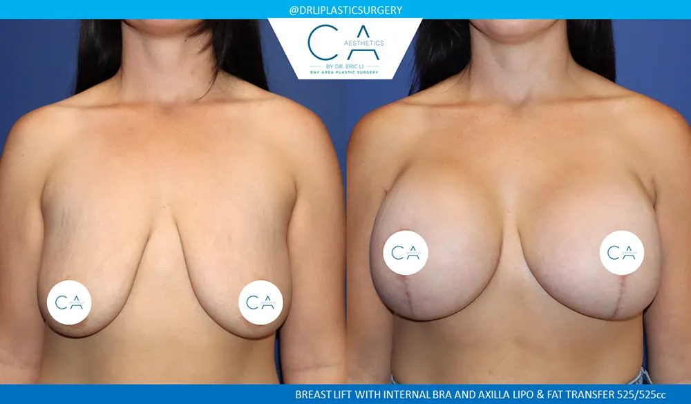 Breast Lift case #9405