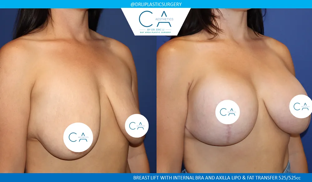 Breast Lift case #9405