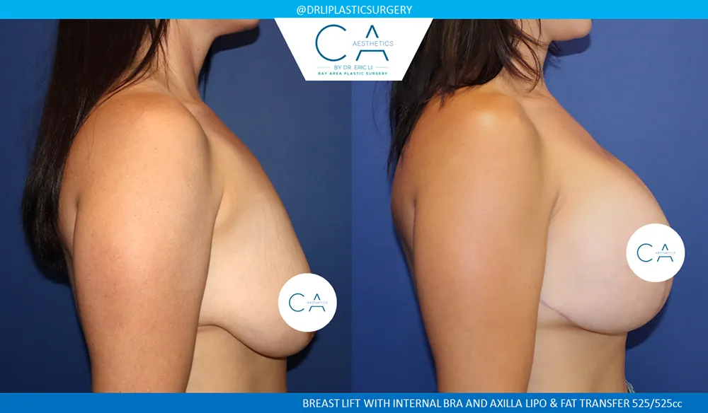 Breast Lift case #9405