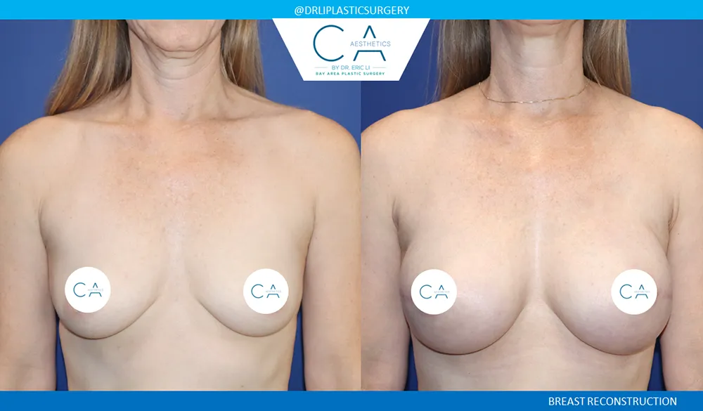 Breast Reconstruction case #9651