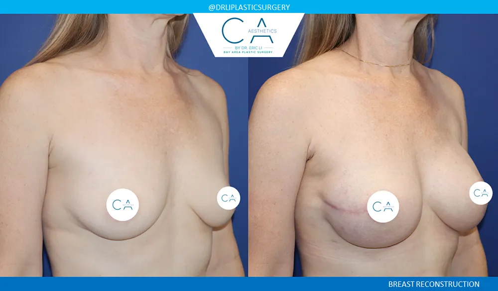 Breast Reconstruction case #9651