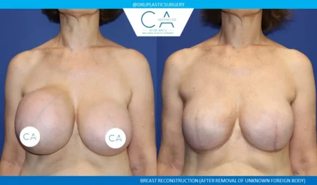Breast Reconstruction case #9645