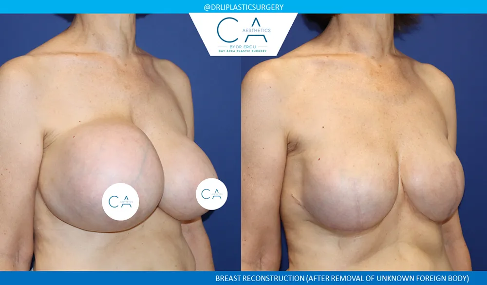 Breast Reconstruction case #9645