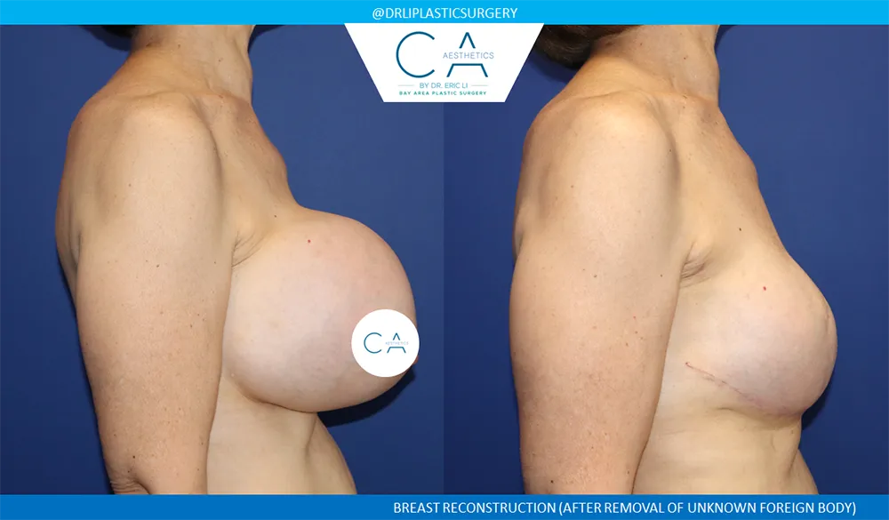Breast Reconstruction case #9645