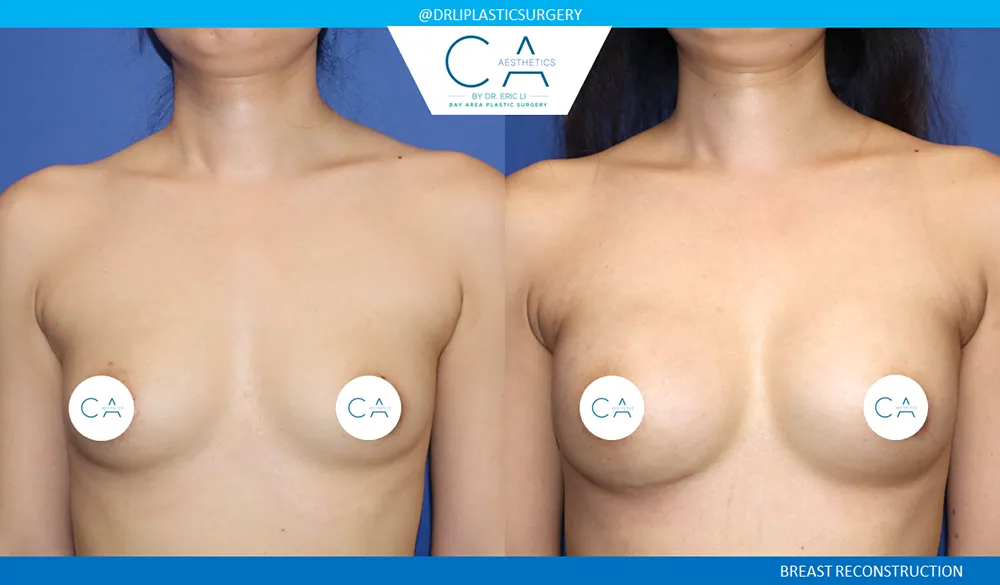 Breast Reconstruction case #9639