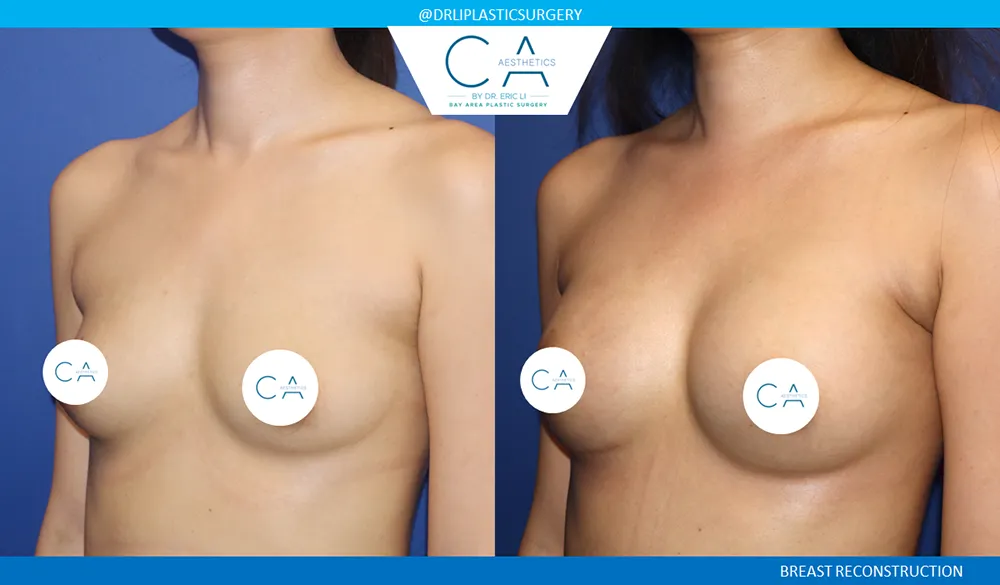 Breast Reconstruction case #9639
