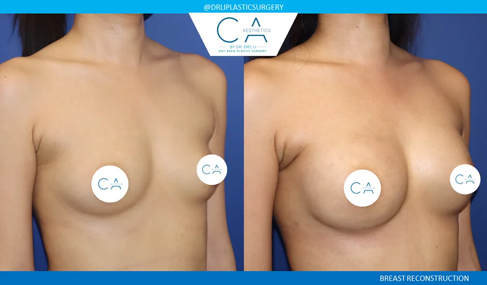 Breast Reconstruction case #9639