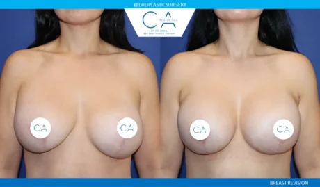 Breast Revision case #9538