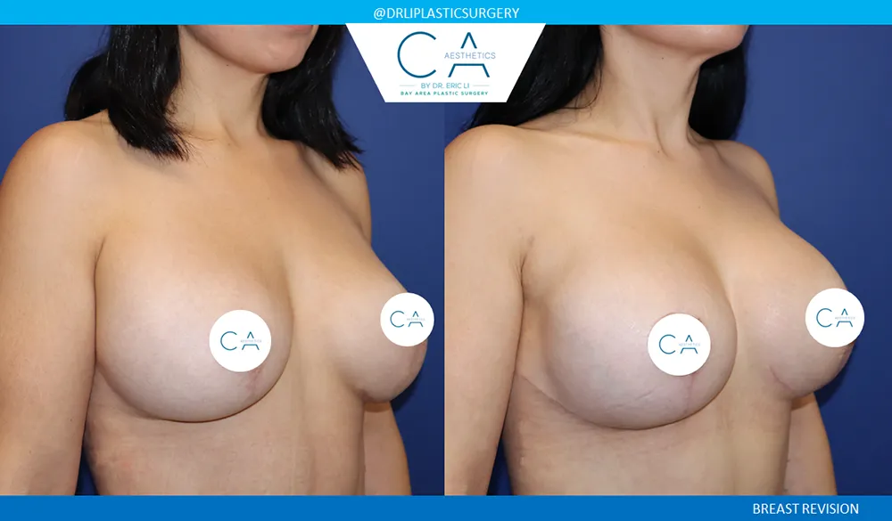 Breast Revision case #9538