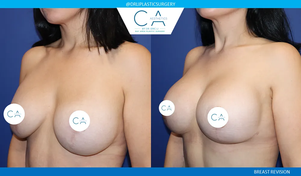 Breast Revision case #9538