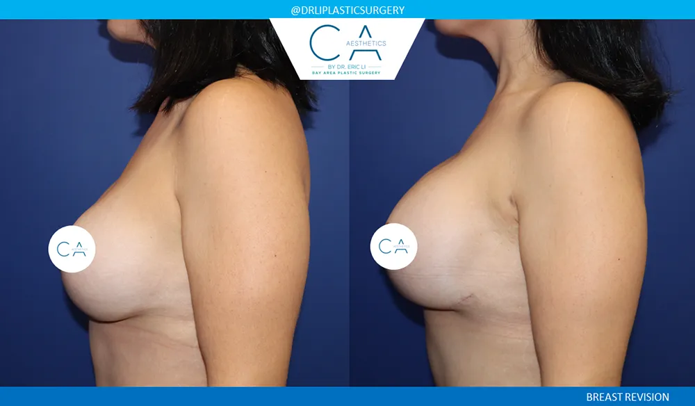 Breast Revision case #9538