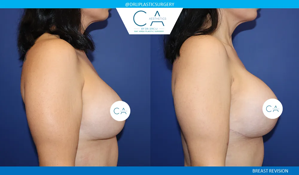 Breast Revision case #9538