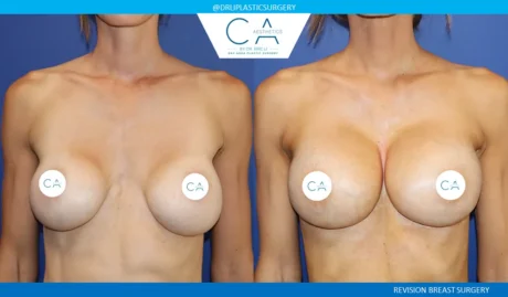 Breast Revision case #9533