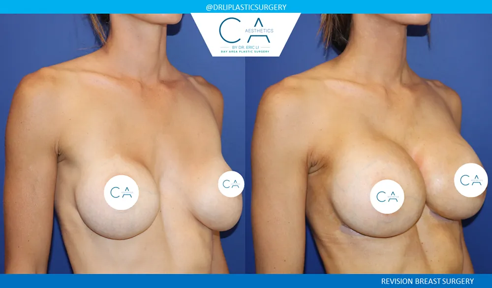 Breast Revision case #9533