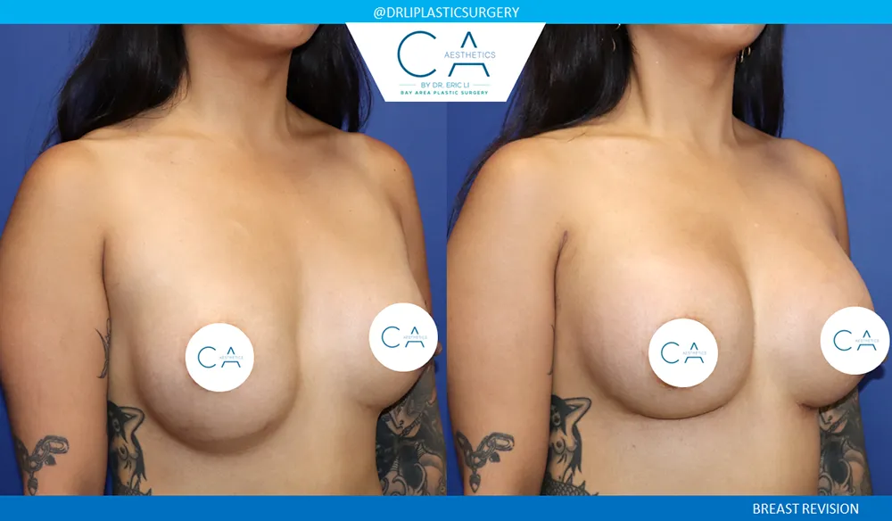 Breast Revision case #9527